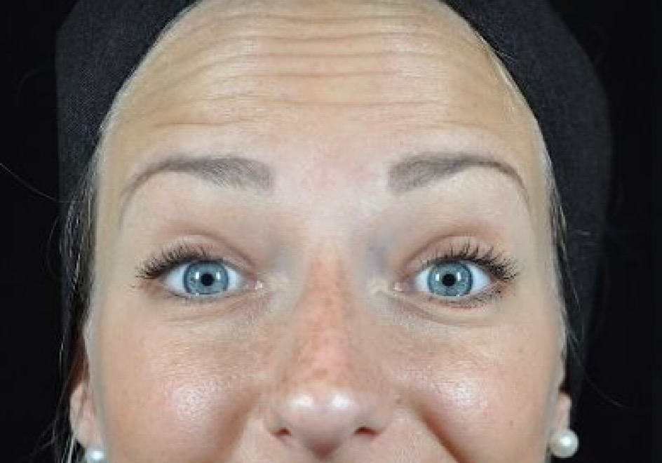 Baby-botox Baby-botox