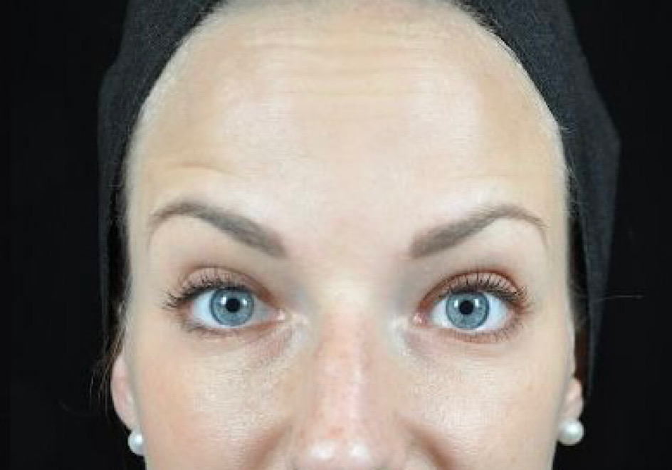 Baby-botox Baby-botox