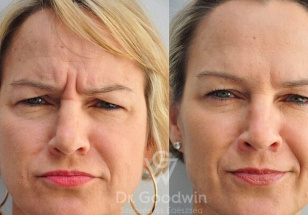 Botox before after