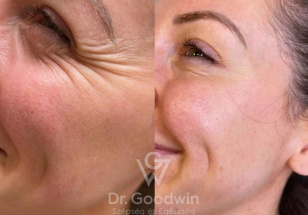 No more wrinkle before after