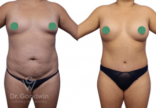 Zsírleszívás műtét előtt és után