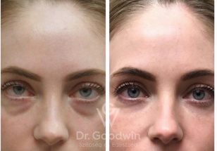 under eyes hoops before and after, Hyaluronic acid