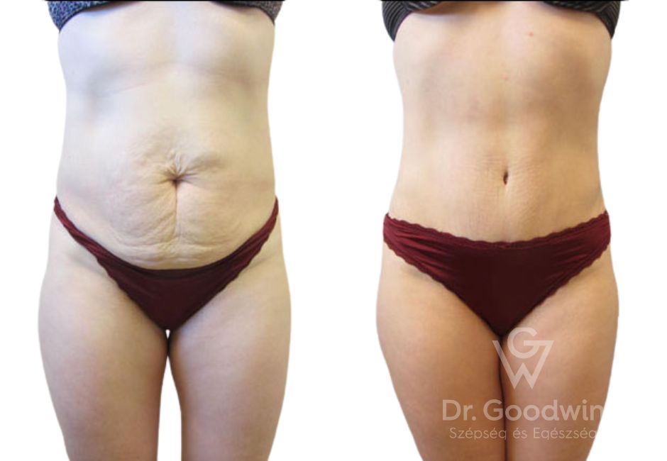 Tummy tuck surgery, Apron belly removal, Prices