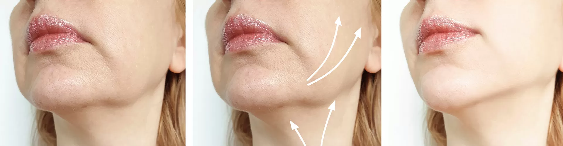 Jawline Contouring