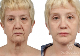 Ingyenes plasztikai konzultáció, arcplasztika